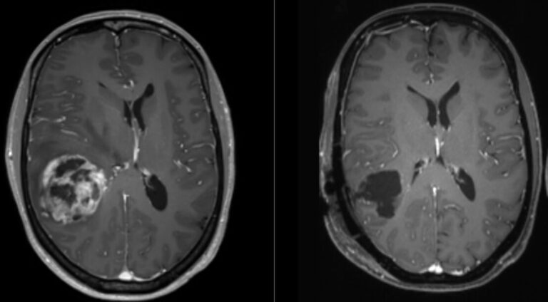 Antidepressivum gegen Hirntumor